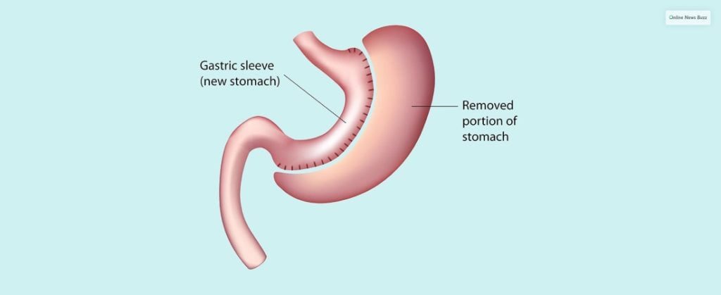 What Bougie Size Is Ideal For Vertical Sleeve Gastrectomy?