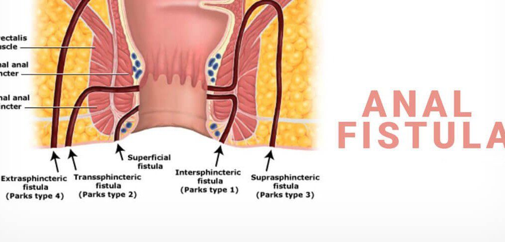 Anal Fistula