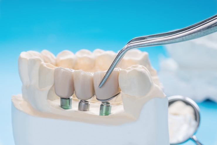 dental implant complication