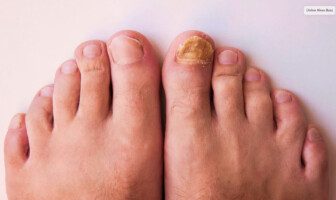 How to know if toenail fungus is dying
