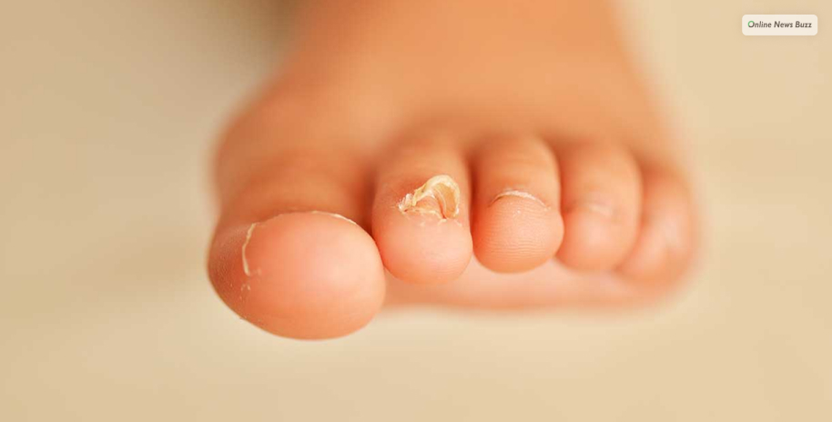 Signs To Know_ Toenail Fungus Is Dying!