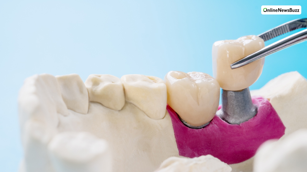 Cheapest Dental Crown Option in 2025