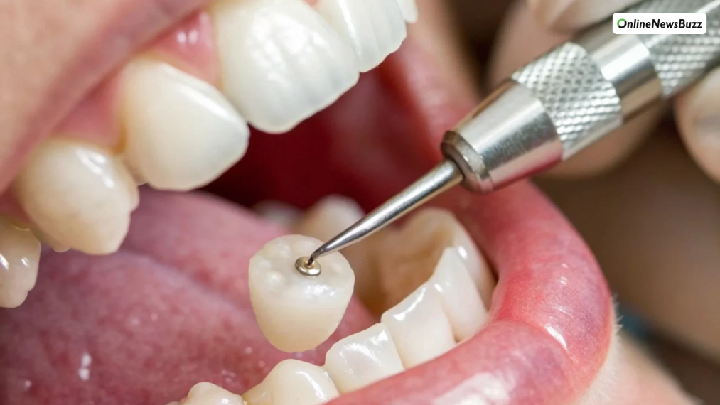 Cost of Dental Crowns Without Insurance in 2025